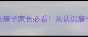 痦子是什么宝宝长痦子家长必看从认识痦子到科学护理全攻略