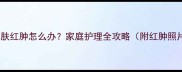 婴幼儿皮肤红肿怎么办家庭护理全攻略附红肿照片对比